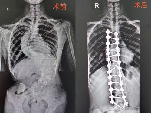女孩脊柱侧弯80度