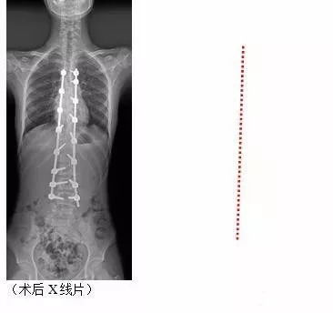 女孩脊柱侧弯80度