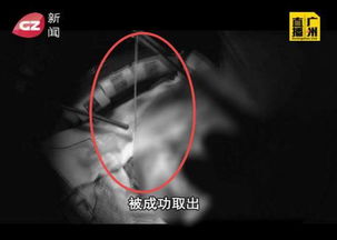 颅内寄生虫活8年