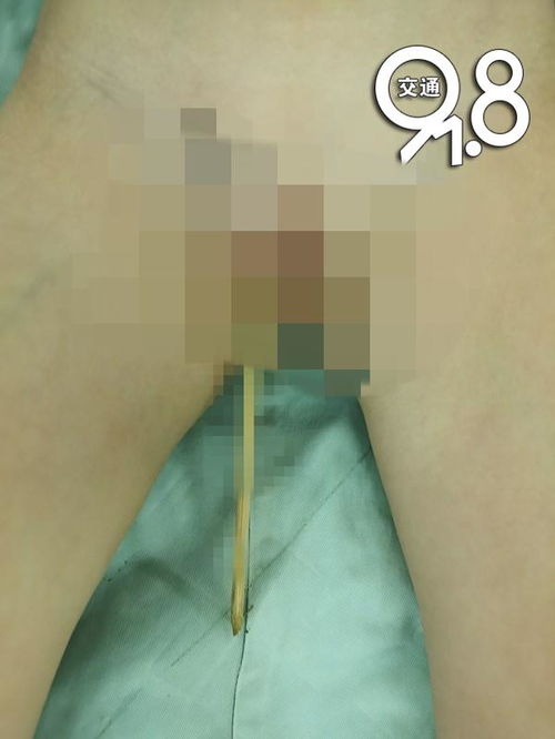 摔倒被竹签刺入小脑