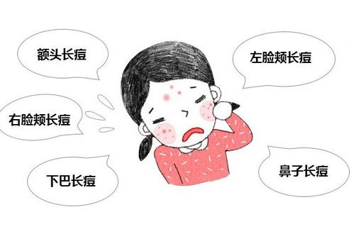 为什么春天容易长痘