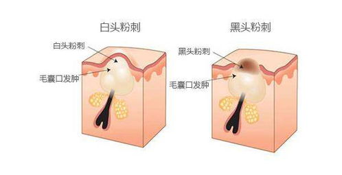 挤痘痘玩具内含针头