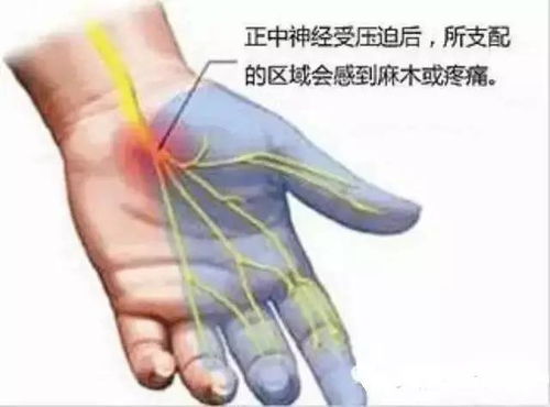 手指发麻确诊烟雾病