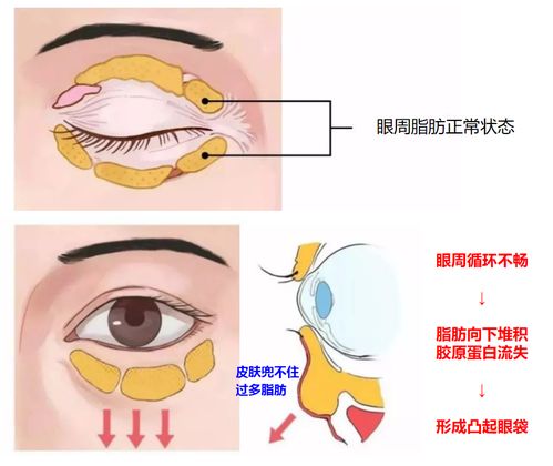 自学割眼袋致1人失明(割眼袋知乎) 自学割眼袋致1人失明(割眼袋知乎)