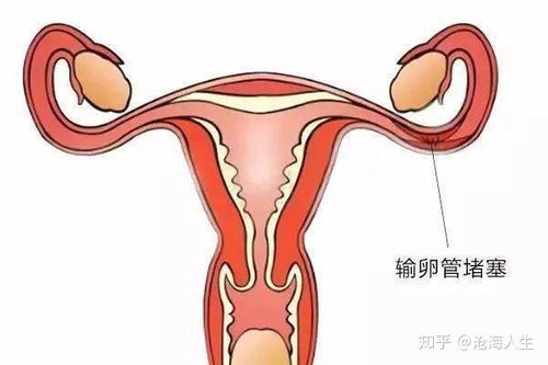 切除输卵管丈夫离婚(输卵管切除离婚孩子归谁) 切除输卵管丈夫离婚(输卵管切除离婚孩子归谁)