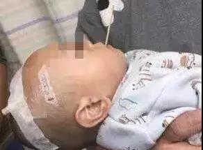 娃摔倒被钩针插颅脑(娃摔倒被钩针插颅脑有事吗) 娃摔倒被钩针插颅脑(娃摔倒被钩针插颅脑有事吗)